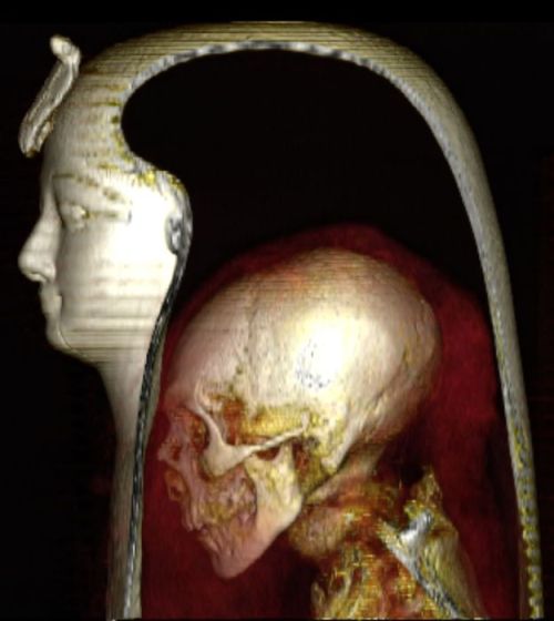 Mumia faraona. Na zdjęciu widać pozycję czaszki i szkieletu wewnątrz osłony z bandaży, źródło: S. Saleem i Z. Nuwass