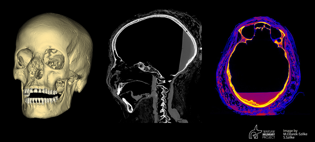 Digital model of the skull and cross-sections through the skull with visible traces of tumor progression. Credit: S.Szilke/WarsawMummyProject