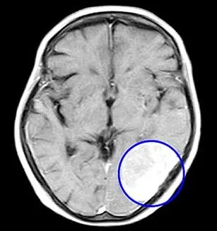 Obraz MRI mózgu pokazujący oponiaka. Fot. Marcin Kowalski/WAT