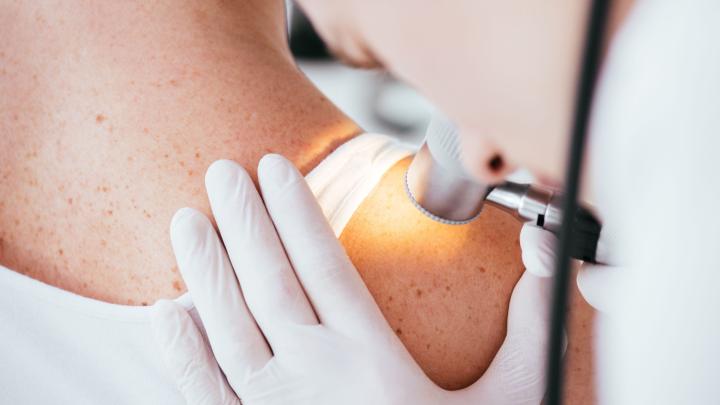 Esperti: il numero di casi di cancro della pelle è quasi raddoppiato negli ultimi dieci anni