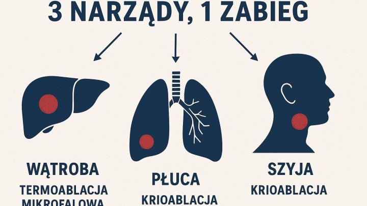 Warszawa/Trzy narządy zoperowane w jednym mało inwazyjnym zabiegu przez specjalistów WUM