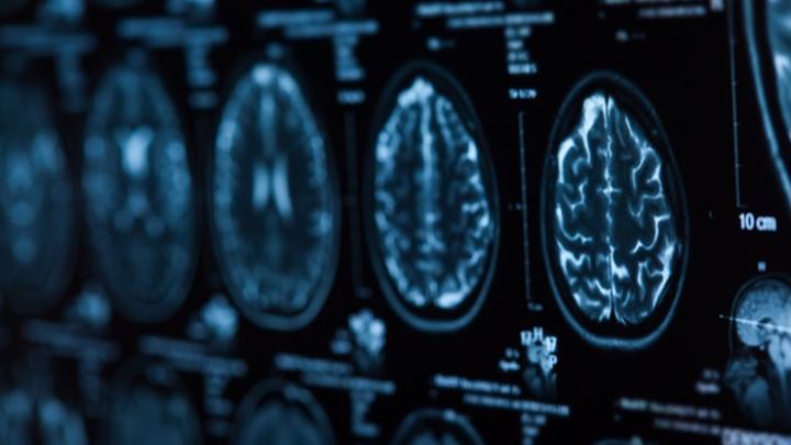 Podkarpackie/ Mieleccy neurochirurdzy zoperowali glejaka w obszarze ruchowym mózgu