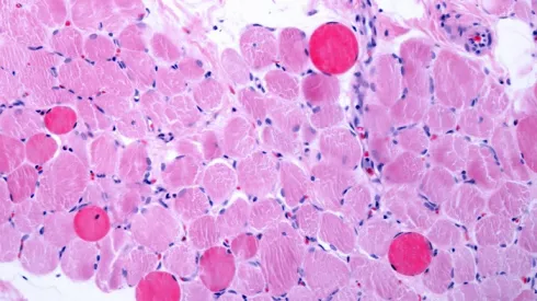 Dystrofia mięśniowa, Adobe Stock