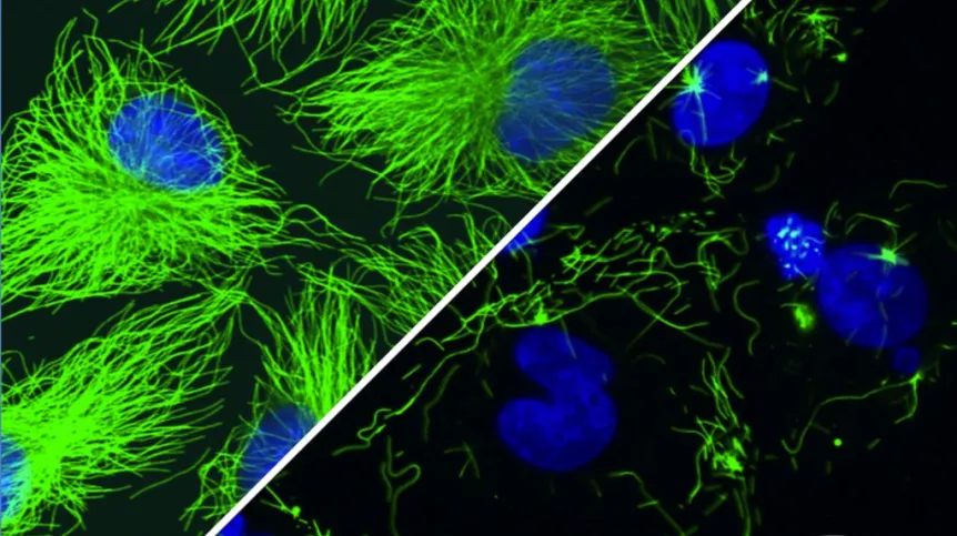 Komórki raka piersi. Fotostatyna aktywowana niebieskim światłem niszczy cytoszkielet komórki, potrzebny do jej podziału. Komórka, która w tej sytuacji chciałaby się podzielić i nie może tego uczynić, ulega samodestrukcji podejmując swoiste „samobójstwo”. W ten sposób szybko dzielące się komórki rakowe same się eliminują. Źródło: Małgorzata Borowiak LMU Monachium 