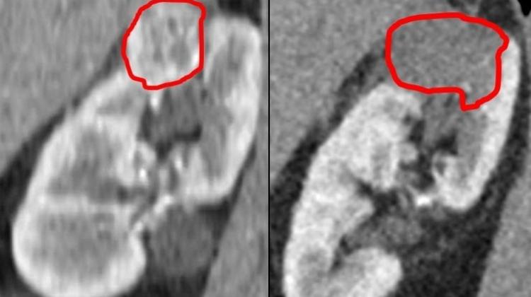 Krioablacja raka nerki przed i po.– po stronie lewej widoczny jest guz, a po prawej - martwica w miejscu po zniszczonym guzie. Fot. Rafał Śledziński / Boston Scientific Polska