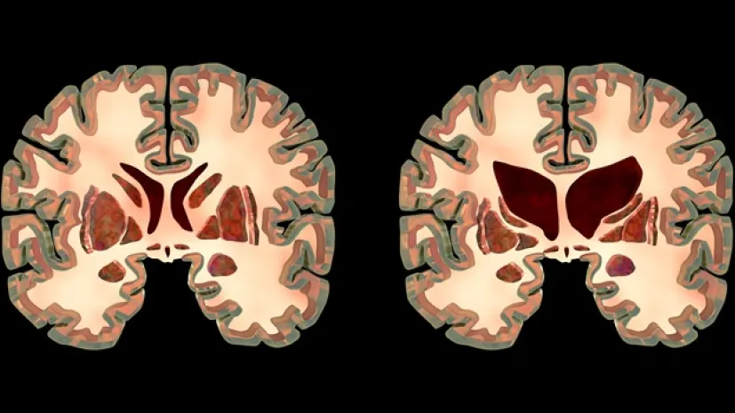 Przekrój mózgu osoby zdrowej i osoby z chorobą Huntingtona, Adobe Stock